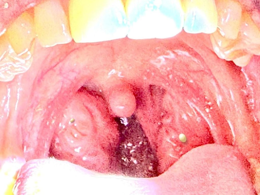 Fotografía clínica de caseum acumulado en criptas amigdalares